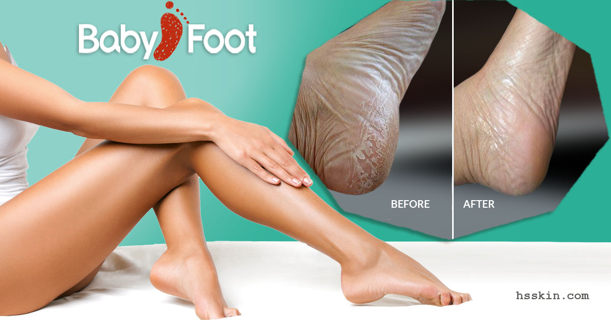 Baby Foot: Exfoliate Your Feet Naturally