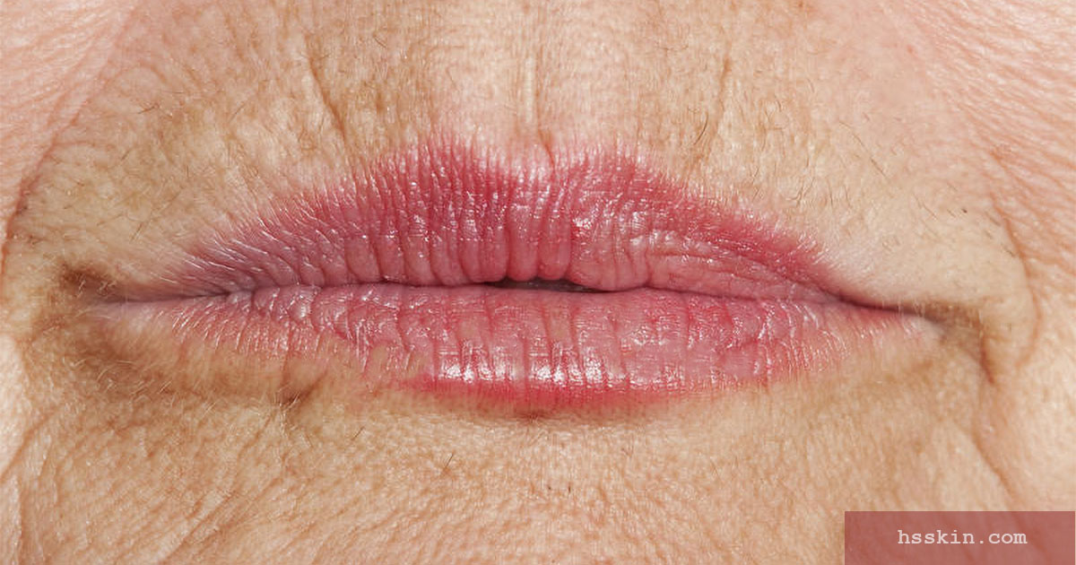 The 6 Best Upper Lip Wrinkle Treatments